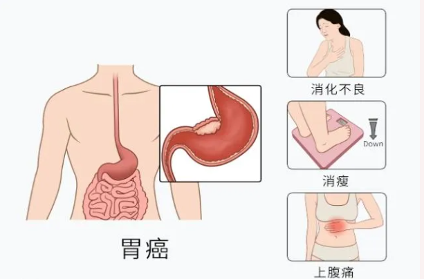 魔高一尺，道高一丈：胃腸鏡—消化道早癌克星